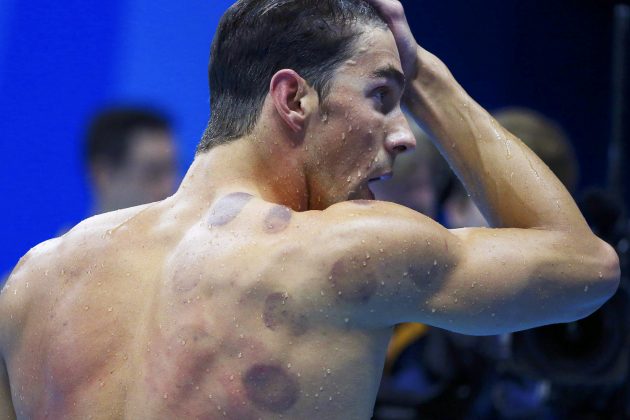 Marcas da Ventosaterapia no nadador Michael Phelps.