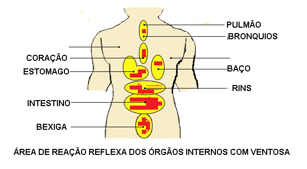 Locais de aplicação para Ventosaterapia.