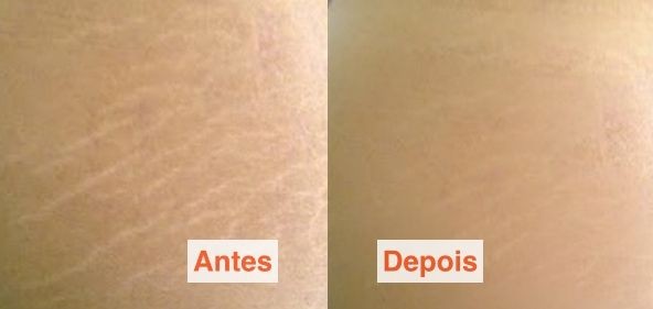 Carboxiterapia para estrias antes e depois